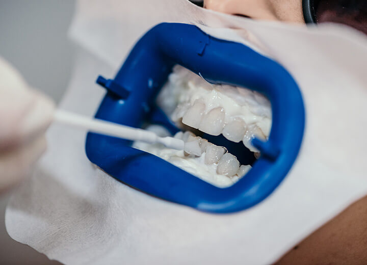 Dental whitening treatment in progress